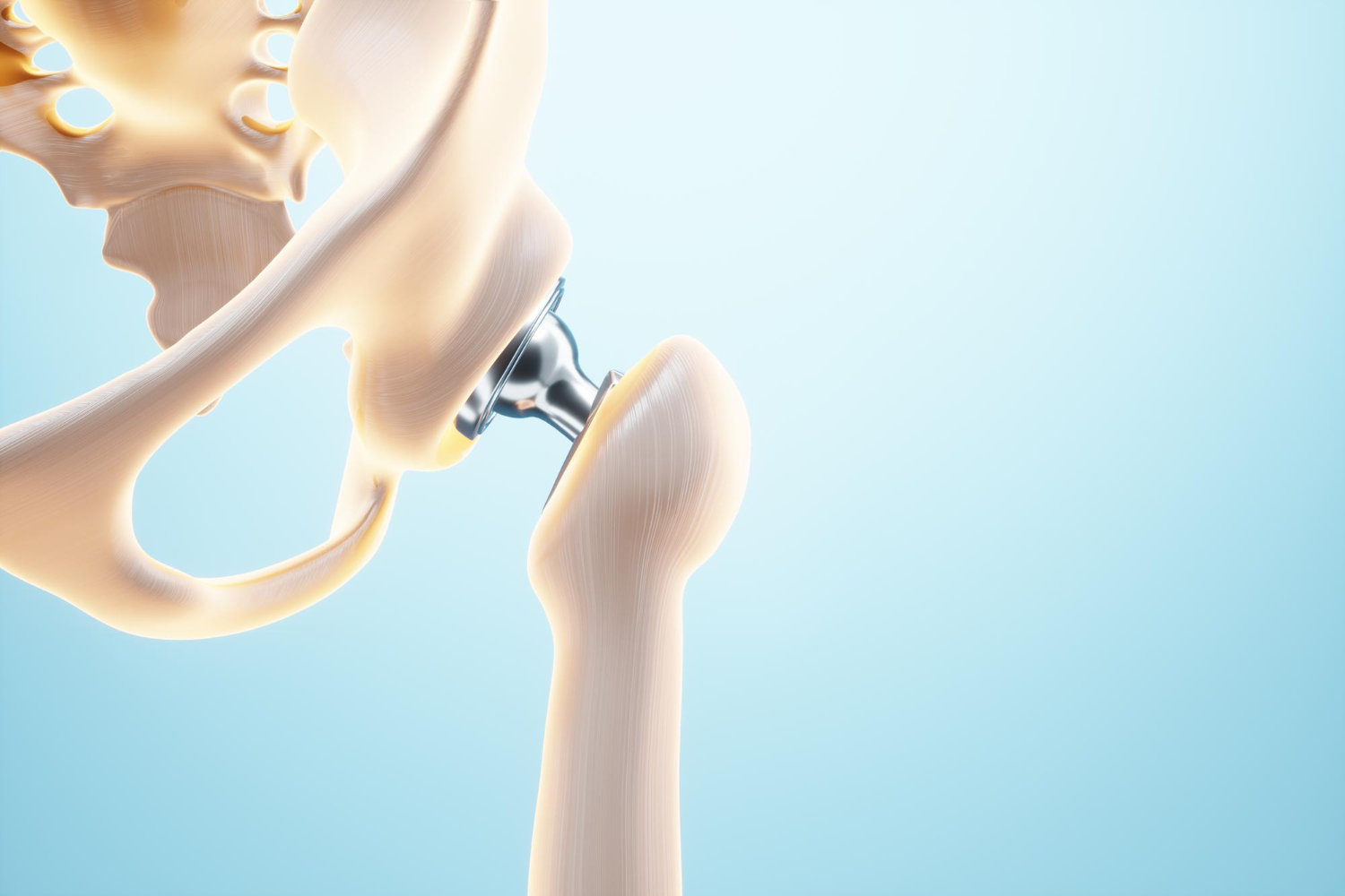 Total Hip Replacement